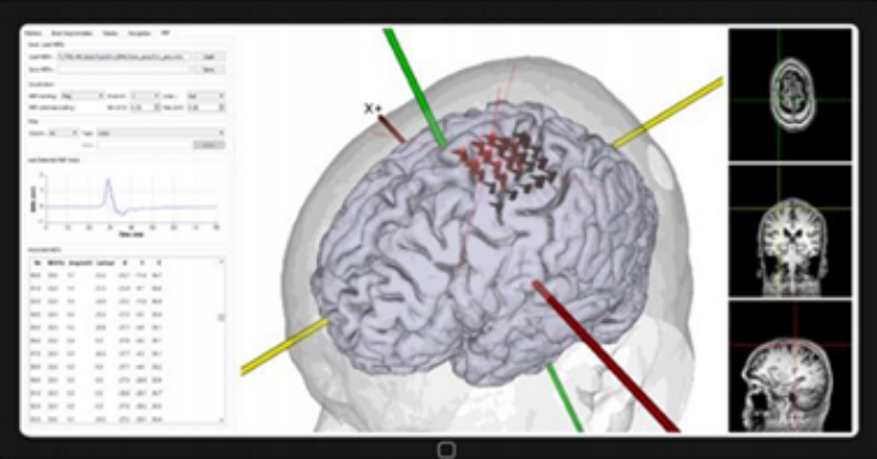 stimolazione transcranica stimolazione cerebrale