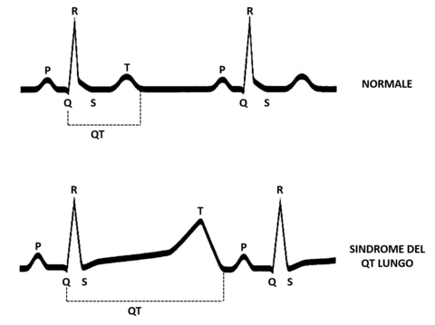 Sindrome QT Lungo Elettrocardiogramma Sindrome QT Lungo Elettrocardiogramma