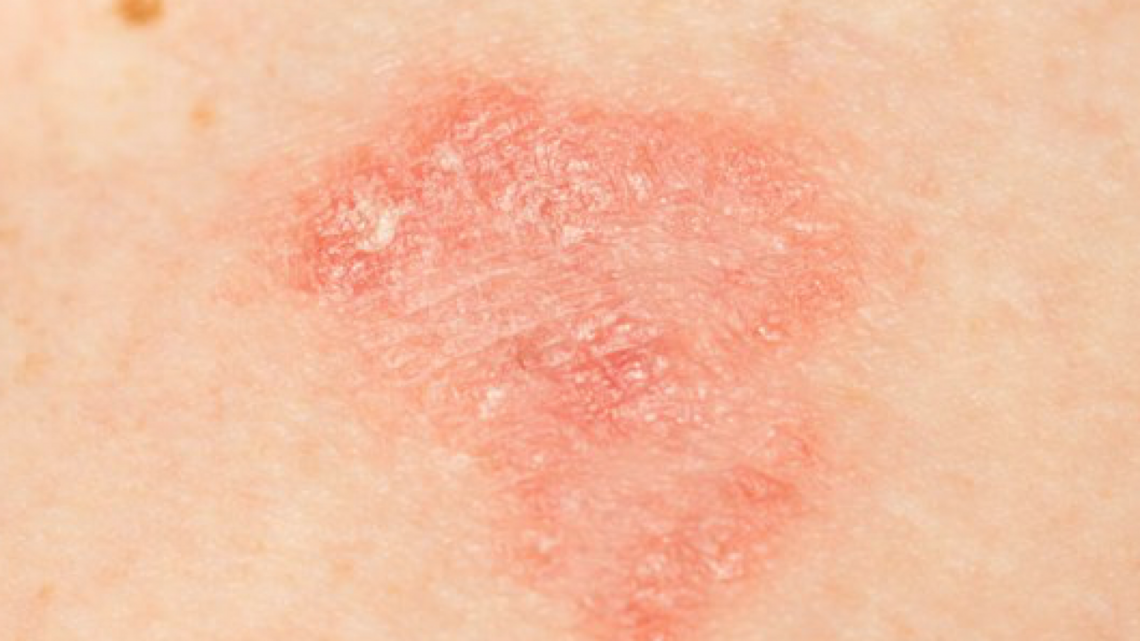 Dermatite atopica