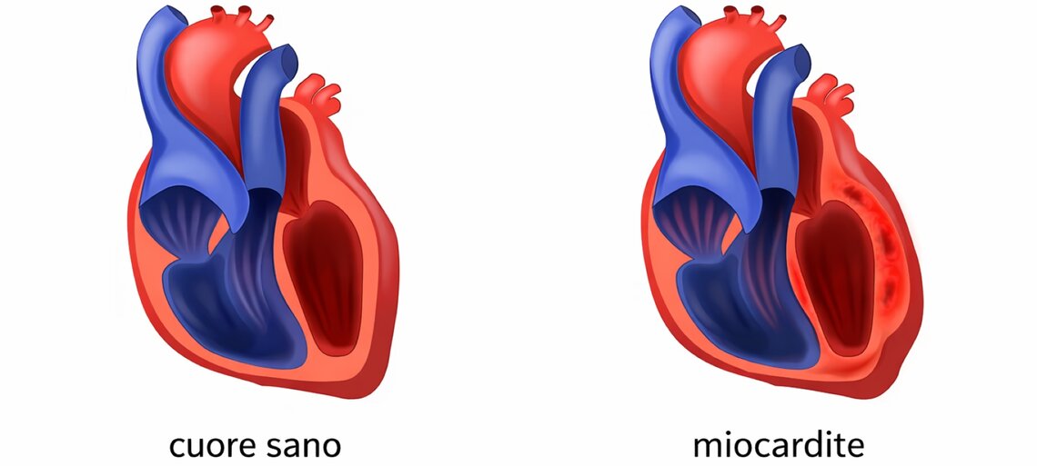 miocardite